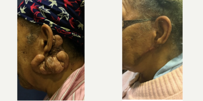 Scar Removal before and after photo