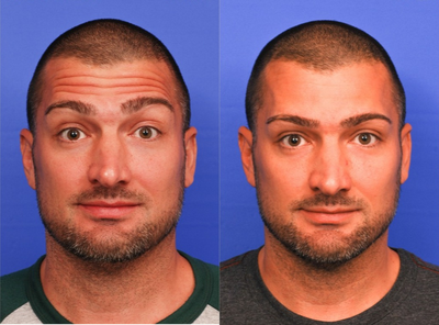 Botox before and after photo
