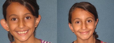 Ear Surgery before and after photo