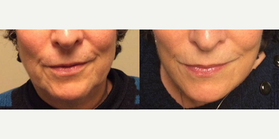 Juvederm before and after photo