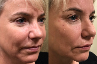 Lip Fillers before and after photo