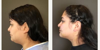 Liposuction before and after photo