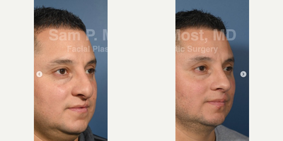 Revision Rhinoplasty before and after photo