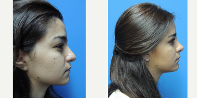 Rhinoplasty before and after photo