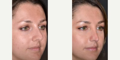 Rhinoplasty before and after photo