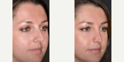 Rhinoplasty before and after photo