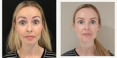 Botox before and after photo