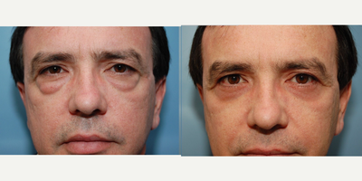 Eyelid Surgery before and after photo