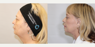 Facelift before and after photo