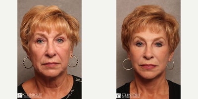 Facelift before and after photo