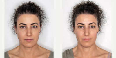 Juvederm before and after photo