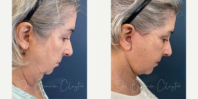 Neck Lift before and after photo
