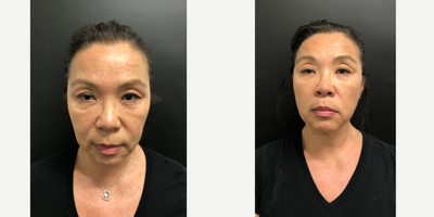 Botox before and after photo