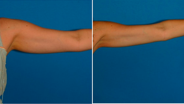 Liposuction before and after photo