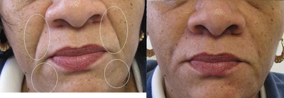 Restylane before and after photo