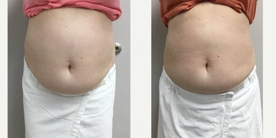Skin Tightening before and after photo