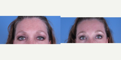 Brow Lift before and after photo