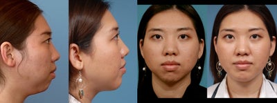 Chin Implant before and after photo