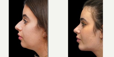 Chin Implant before and after photo