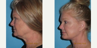 Facelift before and after photo