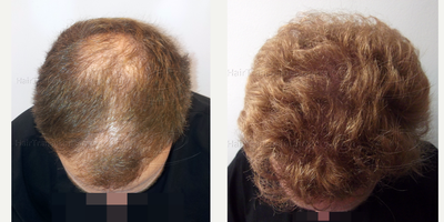 Hair Transplant before and after photo
