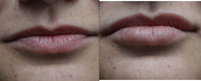 Juvederm before and after photo