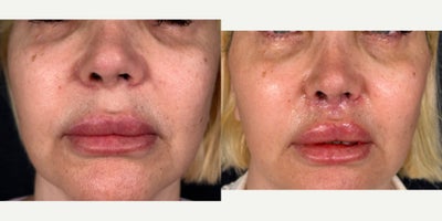 Lip Lift before and after photo