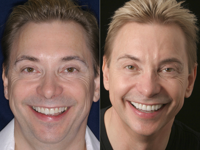 Porcelain Veneers before and after photo