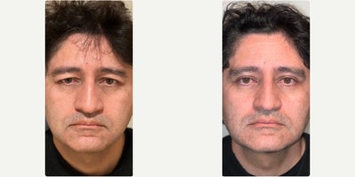 Botox before and after photo