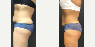 CoolSculpting before and after photo