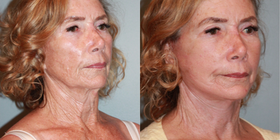 Facelift before and after photo