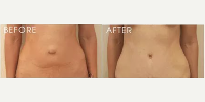 Tummy Tuck before and after photo