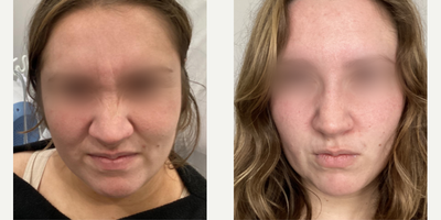 Botox before and after photo