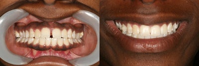 Invisalign before and after photo