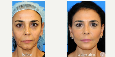 Liquid Facelift before and after photo