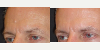 Mole Removal before and after photo
