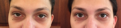 Restylane before and after photo