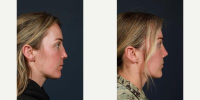 Septoplasty before and after photo