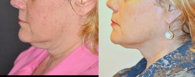 Ultherapy before and after photo