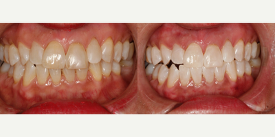 Zoom Whitening before and after photo