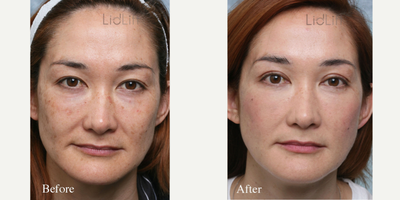 Chemical Peel before and after photo