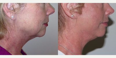 Facelift before and after photo