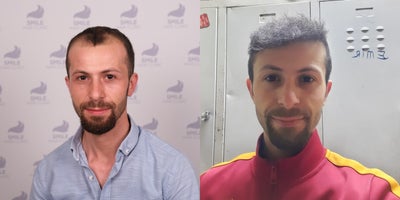 Hair Transplant before and after photo