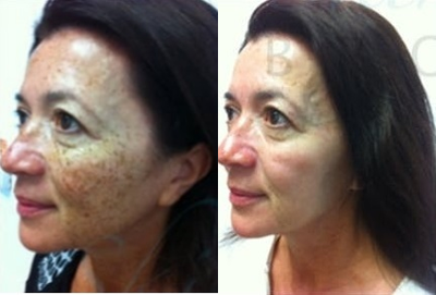 IPL before and after photo