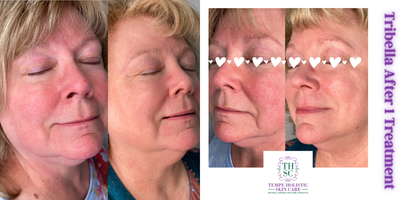 Microneedling before and after photo