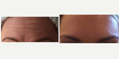 Botox before and after photo