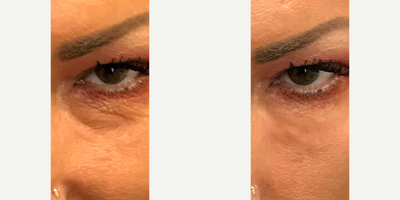Dermal Fillers before and after photo