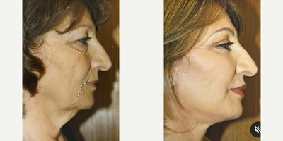 Facelift before and after photo
