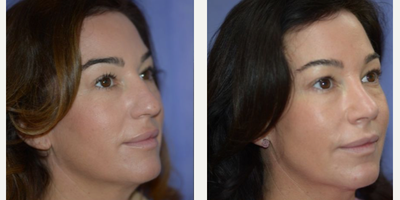 Rhinoplasty before and after photo