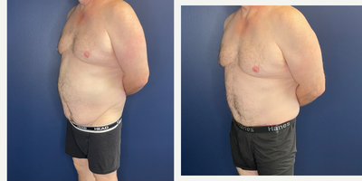 Tummy Tuck before and after photo